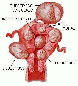 Mioma Uterino